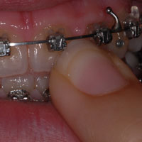 prevenir_ongles