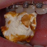 prevenir_popcorn