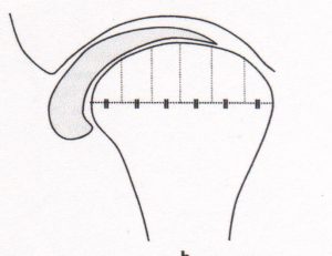 vuecoronale-disquedéplacé-orthodontie-drelafond